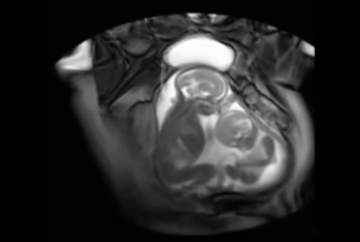 A routine MRI scan revealed twins doing an amazing thing inside their mother’s womb